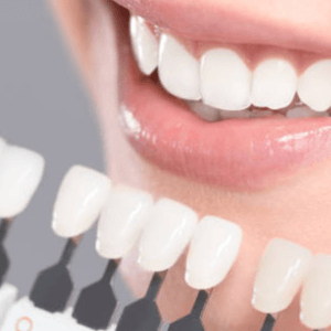 blanchiment-dentaire blanchir-les-dents
